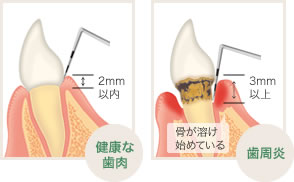 健康な歯肉は深さ2mm以内、歯周炎の歯肉は深さ3mm以上